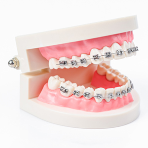 What Are Traditional Dental Braces?